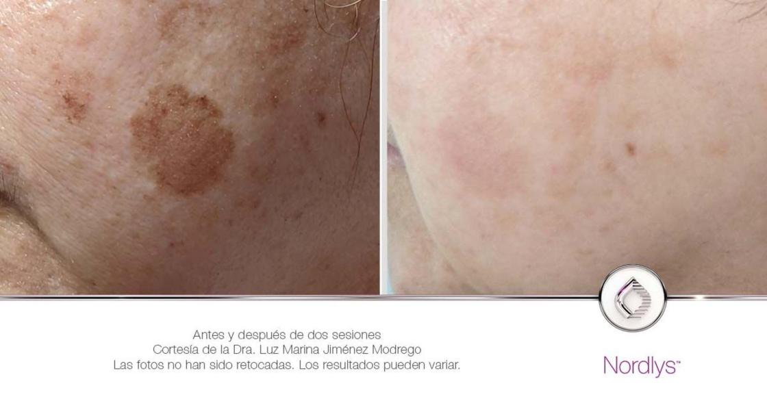 Antes y después con 2 sesiones de NordlysAutor: Dra. Luz Marina Jiménez Modrego