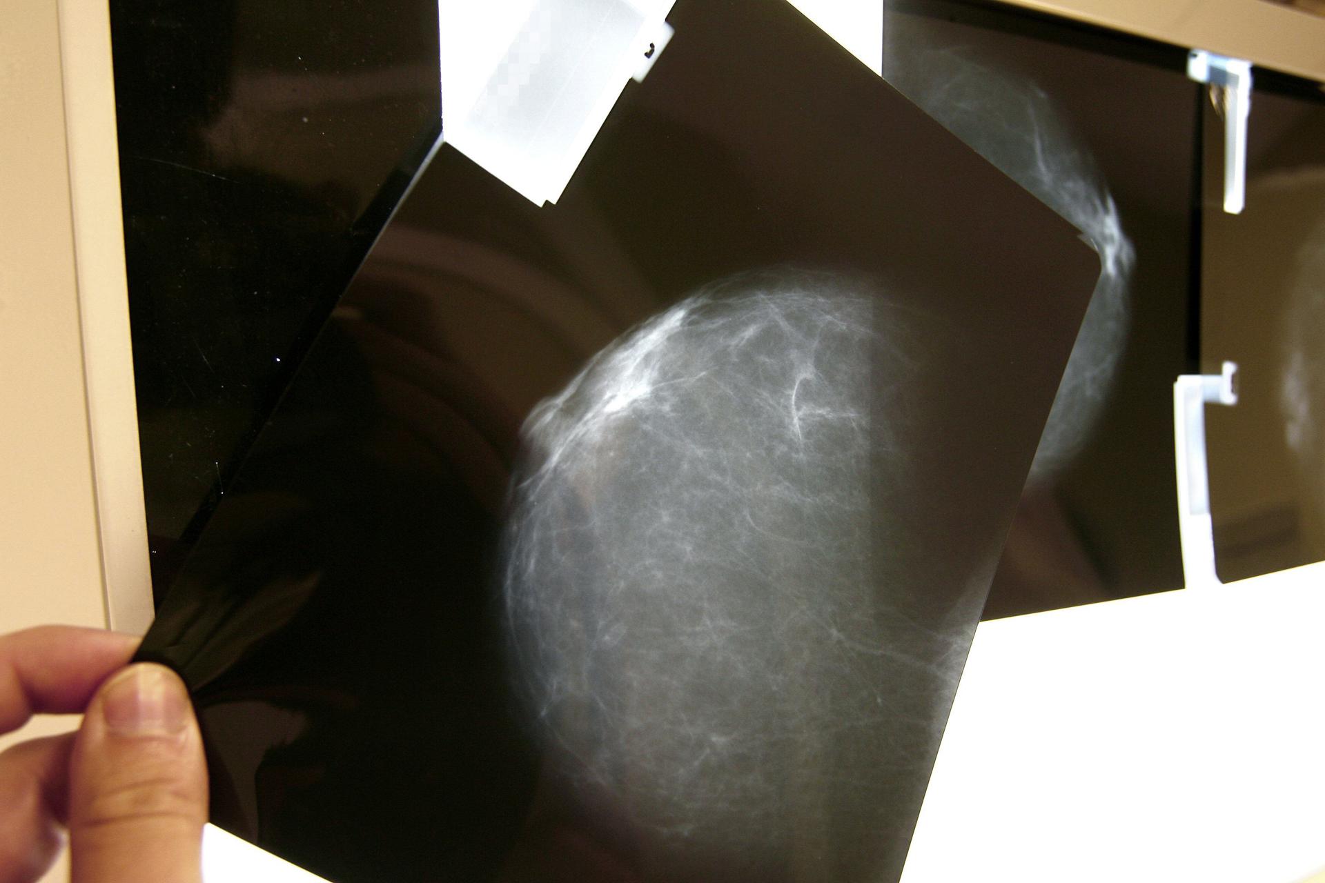 Fotografía de archivo de una prueba radiológica de mama. EFE/Chema Moya