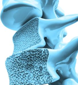 Osteoporosis: La enfermedad silenciosa que causa 70 fracturas por minuto en el mundo. SOLO EDITORIAL/ EFE