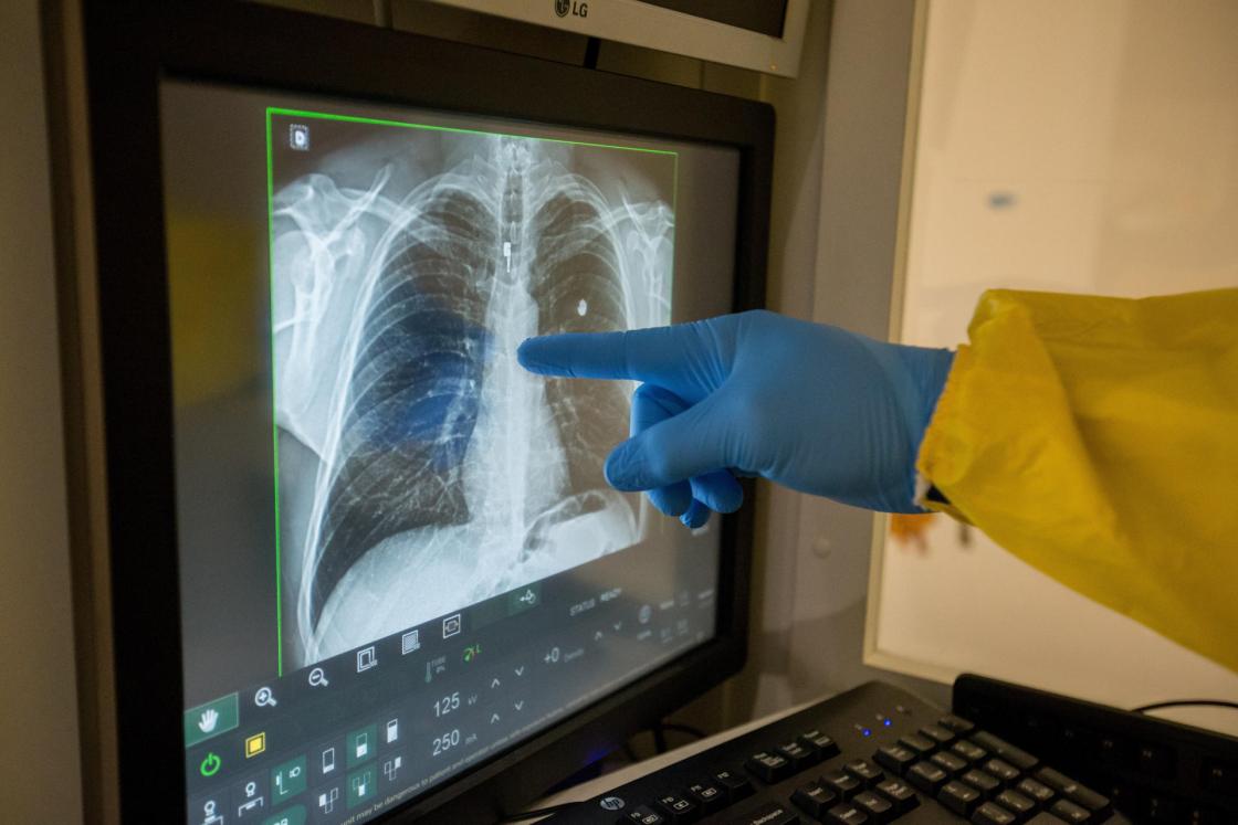 Access to respiratory health remains a major challenge in Latin America, experts warned Thursday at a regional forum, stressing that early diagnosis and preventive education are key to improving millions of lives.EFE/ Toni Albir / ARCHIVO 