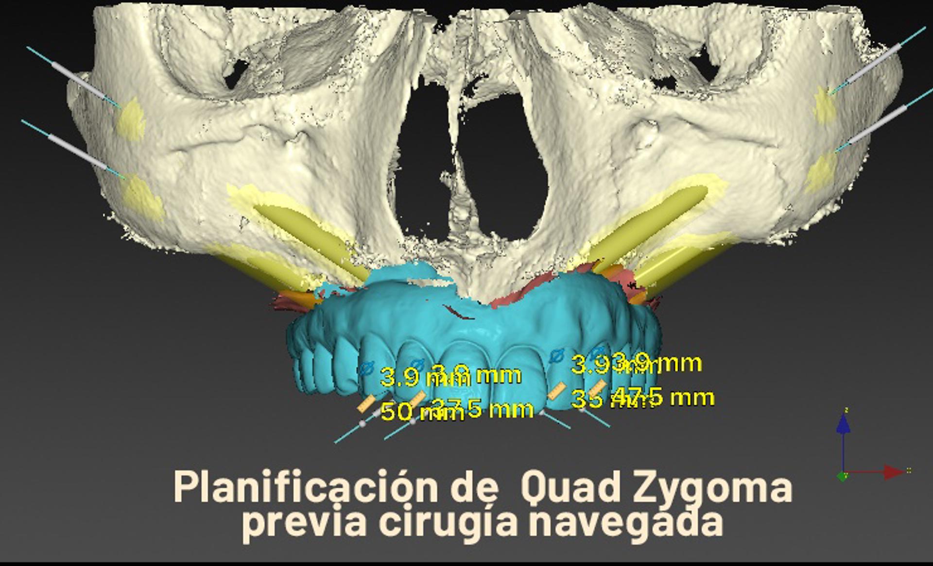 El Dr. Rubén Davó lidera un estudio que avala el Quad Zygoma como rescate para implantes fallidos
